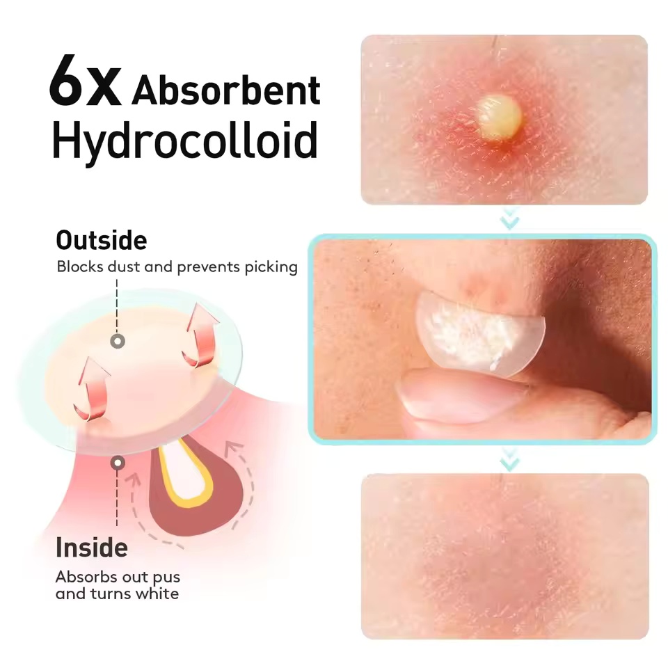 443 stuks gel-acne-pleister op - Skincare Basic recensie en prijs